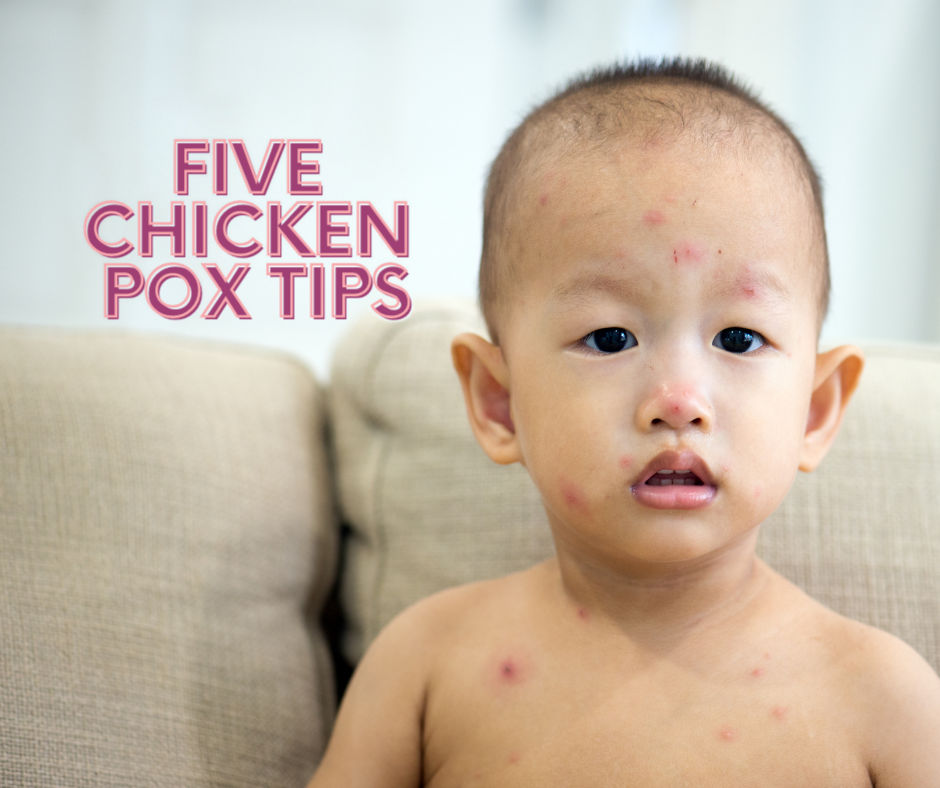 Children Chicken Pox tips
