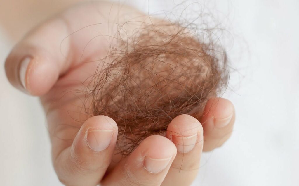 Alopecia hair loss link with Covid