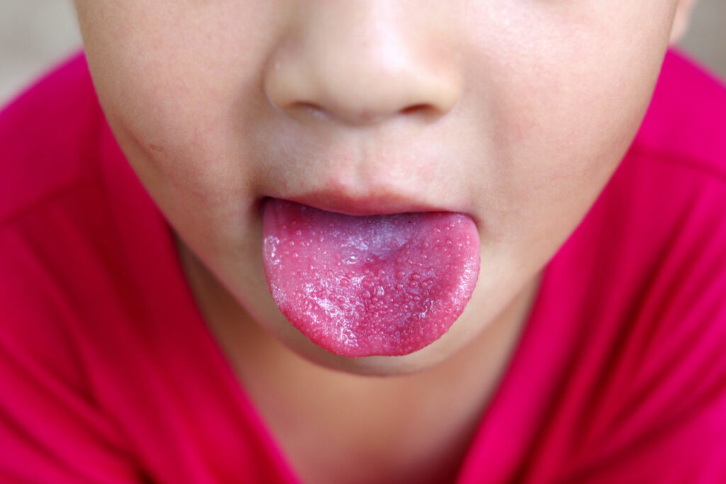 Know about child with Scarlet Fever