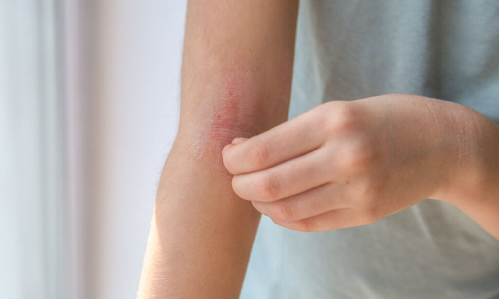 A person scratching a red, irritated patch of skin on their inner elbow, possibly showing symptoms of eczema or dermatitis. The person is wearing a light short-sleeved shirt.